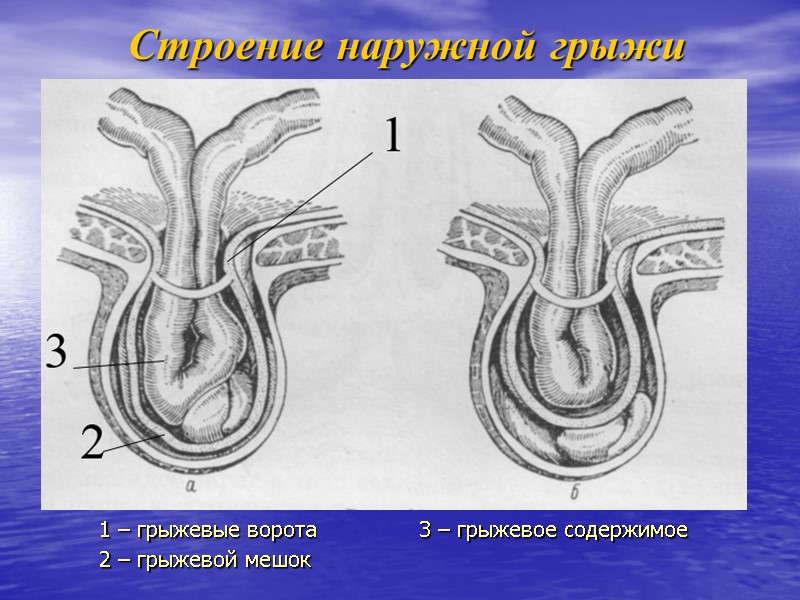 Строение наружной грыжи 1 – грыжевые ворота  3 – грыжевое содержимое 2 –